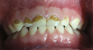 Baby Bottle Tooth Decay