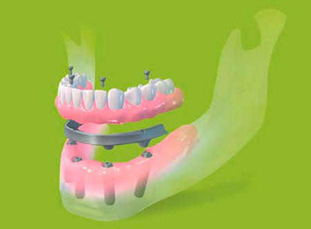 Implant illustration