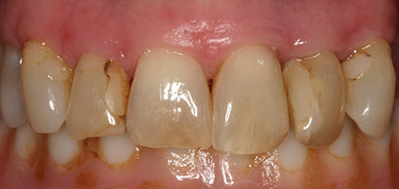 Case five before smile enhancement