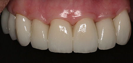 Case five after smile enhancement