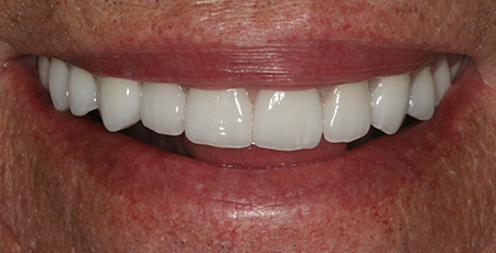 Case sic after smile enhancement