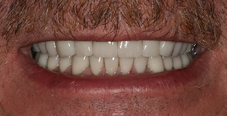 Case One After Prosthodontics