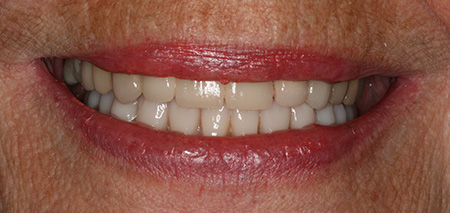 Case two after rehabilitation