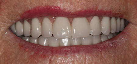 Case Four after smile enhancement